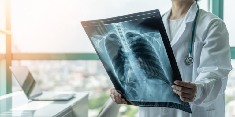 Doctor diagnosing patientâs health on asthma, lung disease, COVID 19 or bone cancer illness with radiological chest x ray film for medical healthcare hospital service