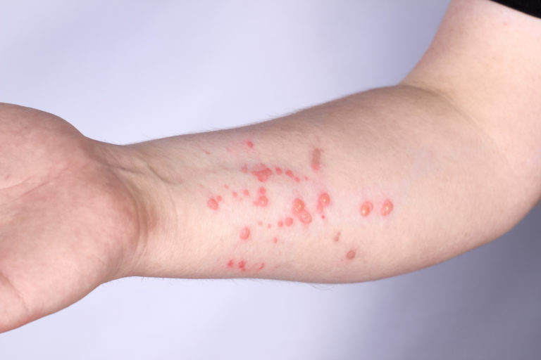 Monkeypox opičie kiahne
