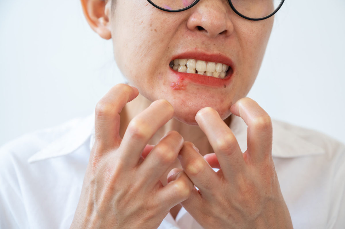 Woman,Feeling,Itch,Cause,Of,Herpes,Labialis,On,Her,Lower