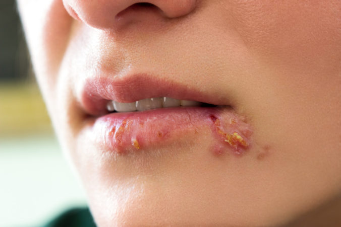 Girl,Lips,Showing,Herpes,Blisters