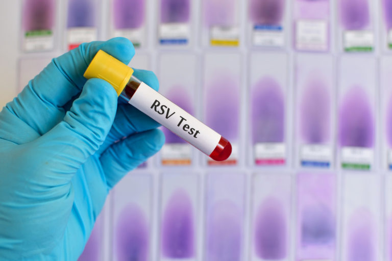 Blood sample for respiratory syncytial virus (RSV) test