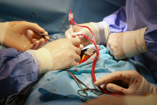 transplantácia srdca