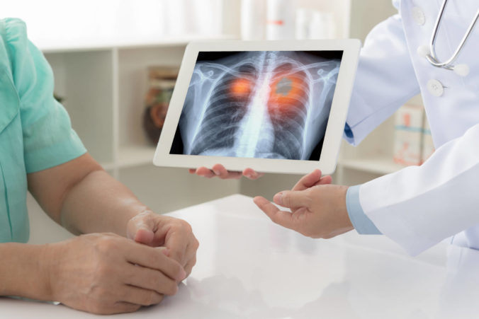 5 mýtov o rakovine pľúc, ktorým je nebezpečné veriť