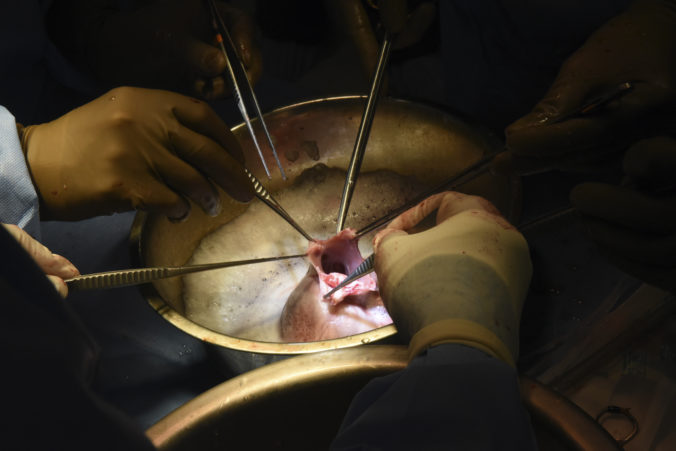 Lekári z Marylandskej univerzity vykonali svoju druhú transplantáciu prasacieho srdca človeku
