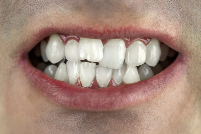 Crooked teeth, wrong bite, close up
