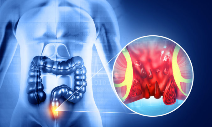 Haemorrhoids (piles) on scientific background. 3d illustration