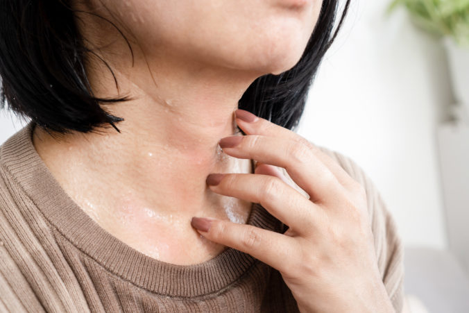 Closeup woman&#039;s hand scratching itchy skin on her neck caused by allergic to sweat