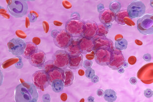 Acute lymphoblastic leukemia ALL cancer cell clusters in the blood flow - isometric view 3d illustration