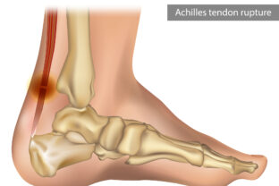Achilles tendon rupture and injury