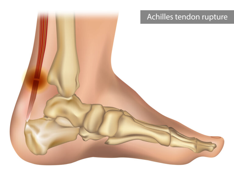 Achilles tendon rupture and injury