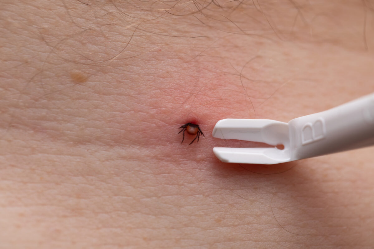 odstránenie kliešťa