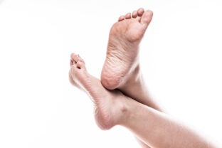Female foot with pedicure and poor over dry skin on the heels of