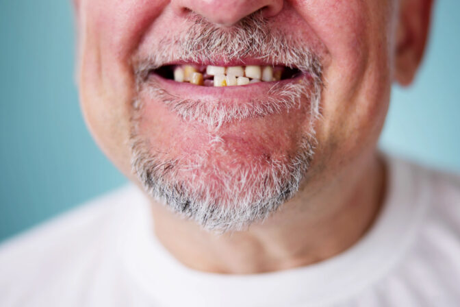 Zuby, chýbajúci zub