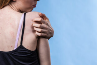 „Nie je to akné, ani banalita.“ Ochorenie hidradenitis suppurativa trápi tisíce ľudí, no diagnózu často dostanú až po rokoch