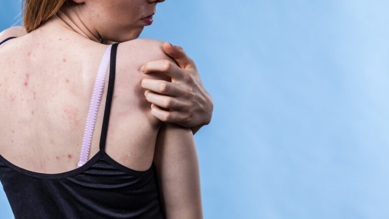 „Nie je to akné, ani banalita.“ Ochorenie hidradenitis suppurativa trápi tisíce ľudí, no diagnózu často dostanú až po rokoch