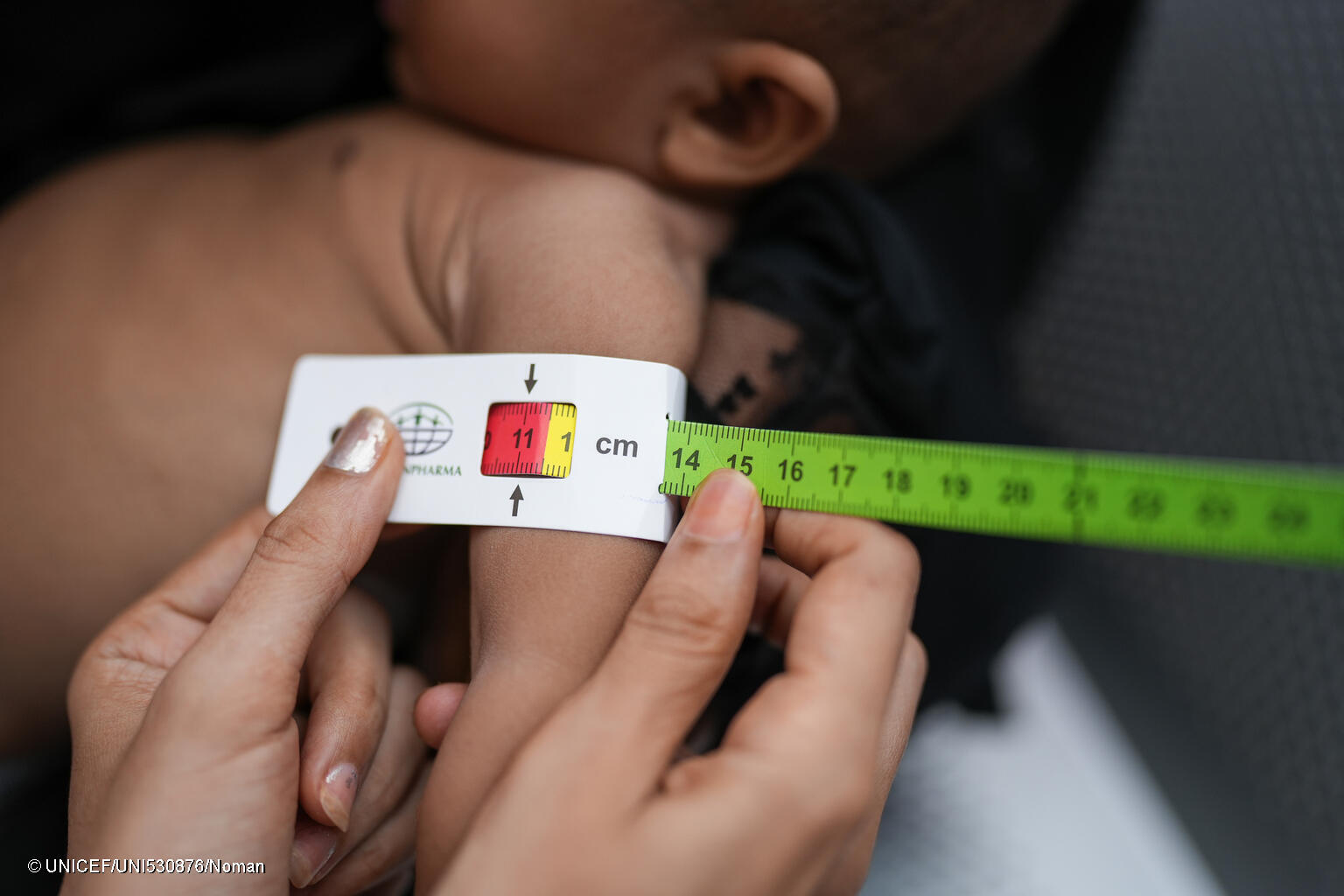 UNICEF YEM 2023 MAY NUTRITION MALNOURISHED CHILDREN STORIES LAHJ
