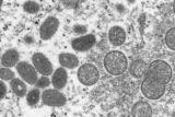 FILE - This 2003 electron microscope image made available by the Centers for Disease Control and Prevention shows mature, oval-shaped monkeypox virions, left, and spherical immature virions, right, obtained from a sample of human skin associated with the 2003 prairie dog outbreak. A leading doctor who chairs a World Health Organization expert group described the unprecedented outbreak of the rare disease monkeypox in developed countries as "a random event" that might be explained by risky sexual behavior at two recent mass events in Europe. ()