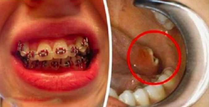 Ak dnes nosíte zubné strojčeky, o pár rokov sa vám môže stať niečo hrozné