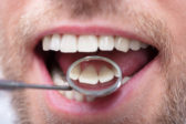 Ako sa zbaviť zubného kameňa a ochorenia ďasien bez drahých procedúr