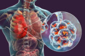 Pneumónia. 5 príčin vzniku zápalu pľúc