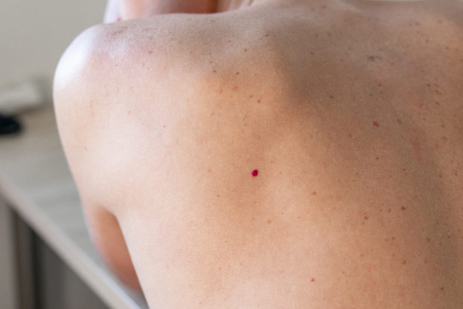 Pokiaľ sa vám na koži objavujú červené škvrnky, nie je nutné mať hneď obavy