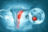 Aké sú príznaky rakoviny vaječníkov?