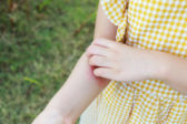 Žihľavka u detí: Ako rozpoznať symptómy a poskytnúť úľavu