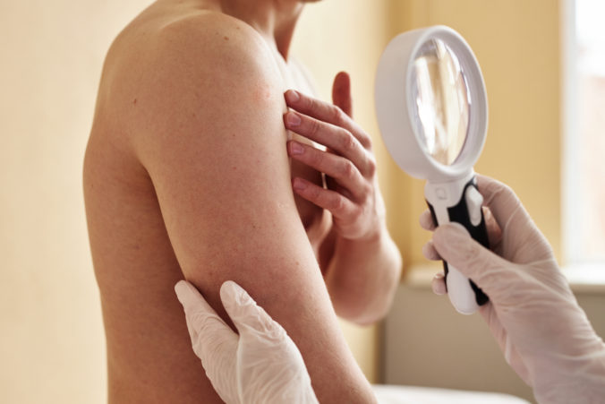 Rakovinu kože pomôže odhaliť včas jeden zanedbávaný príznak