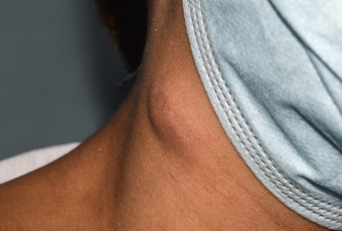 Single swelling or lymph node at the neck
