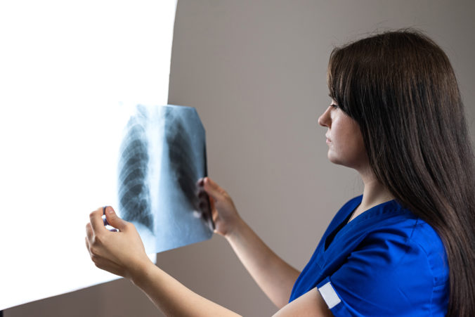 rentgen pľúc