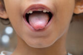 Mliečnik v ústach spôsobuje kvasinka rodu Candida