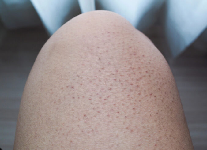 Keratóza pilaris - ochorenie pokožky, ktoré sa dá zvládnuť