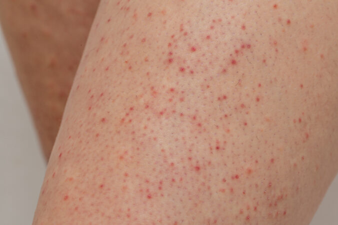 Keratóza pilaris - pokožka s červenými hrbolčekmi