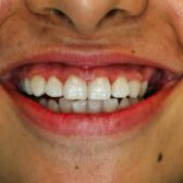 Nezanedbávajte ustupujúce ďasná, môžete prísť o zuby