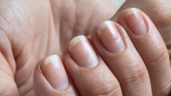 Ako odhaliť problémy s nechtami: niektoré signály sa neoplatí ignorovať