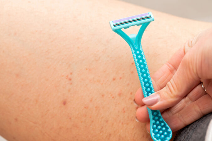 Ako skoncovať s pupienkami po holení intímnych miest raz a navždy