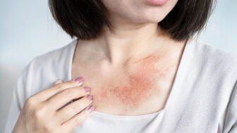 Atopický ekzém: Prečo sa nevyhýba ani dospelým a čím si ho môžeme zhoršiť?
