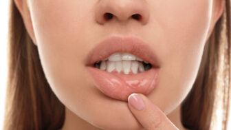 Rýchla pomoc pri opare: čo zabraňuje jeho rozvoju a ako si účinne poradiť doma