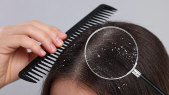 Ako sa nadobro zbaviť lupín: dermatológovia upozorňujú na zásadný zvyk, ktorý rozhoduje o kondícii pokožky hlavy