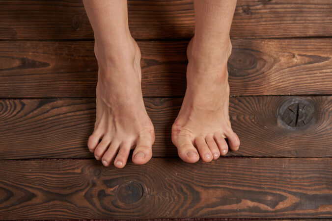 Pleseň nechtov trápi mnohých