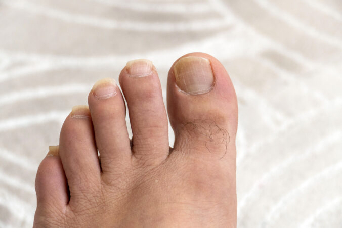 Zmeny na nechtoch ako tichý signál tela