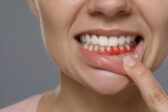 Krvácanie ďasien: ako ho riešiť rýchlo a účinne
