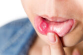 Opakované afty v ústach: prečo sa vracajú a čo môžete urobiť pre ich obmedzenie